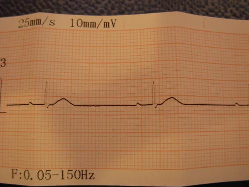 Electocardiogramme_ECG